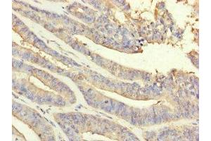 Immunohistochemistry of paraffin-embedded human endometrial cancer using ABIN7162936 at dilution of 1:100 (Peroxiredoxin 2 Antikörper  (AA 2-65))