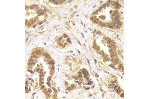 Immunohistochemistry of paraffin-embedded human mammary cancer using ROCK2 antibody (ABIN5973333) at dilution of 1/100 (40x lens). (ROCK2 Antikörper)