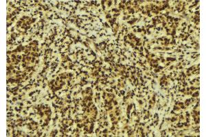 ABIN6274223 at 1/100 staining Human breast cancer tissue by IHC-P. (GTF2E2 Antikörper  (Internal Region))