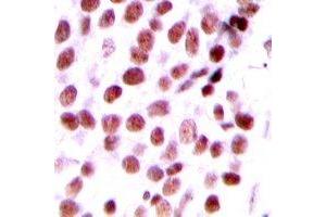 Immunohistochemical analysis of DIDO1 staining in human breast cancer formalin fixed paraffin embedded tissue section. (DIDO1 Antikörper  (N-Term))