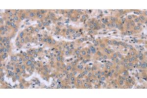 Immunohistochemistry of paraffin-embedded Human liver cancer using MAPRE3 Polyclonal Antibody at dilution of 1:30 (ECE1 Antikörper)