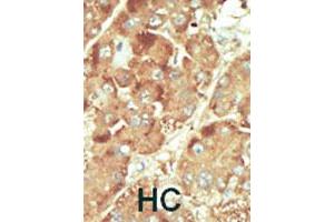 Formalin-fixed and paraffin-embedded human hepatocellular carcinoma tissue reacted with NLK polyclonal antibody  , which was peroxidase-conjugated to the secondary antibody, followed by DAB staining. (Nemo-Like Kinase Antikörper  (C-Term))