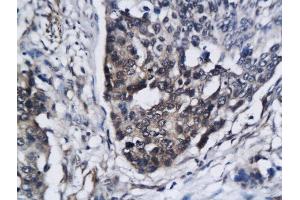 Formalin-fixed and paraffin embedded human breast cancer labeled with Anti SIRT3 Polyclonal Antibody, Unconjugated  followed by conjugation to the secondary antibody and DAB staining (SIRT3 Antikörper  (AA 201-300))