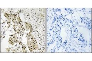 Immunohistochemistry analysis of paraffin-embedded human breast carcinoma, using TAGAP Antibody. (TAGAP Antikörper  (AA 191-240))