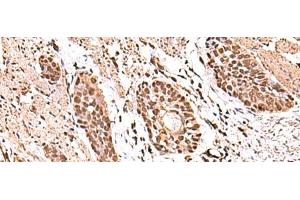 Immunohistochemistry of paraffin-embedded Human esophagus cancer tissue using ACTL6B Polyclonal Antibody at dilution of 1:100(x200)