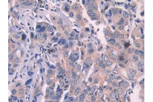 Used in DAB staining on fromalin fixed paraffin- embedded stomach cancer tissue (OAS1 Antikörper  (AA 74-165))