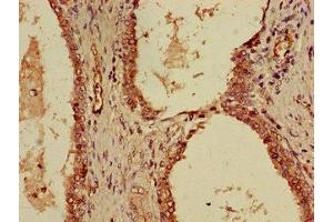 Immunohistochemistry of paraffin-embedded human prostate cancer using ABIN7156122 at dilution of 1:100 (KPNA4 Antikörper  (AA 51-239))