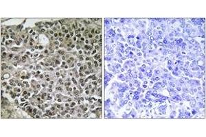 Immunohistochemistry analysis of paraffin-embedded human breast carcinoma tissue, using NFAT3 (Ab-676) Antibody. (NFATC4 Antikörper  (AA 642-691))