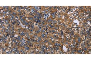 Immunohistochemistry of paraffin-embedded Human ovarian cancer tissue using LGALS2 Polyclonal Antibody at dilution 1:30 (Galectin 2 Antikörper)