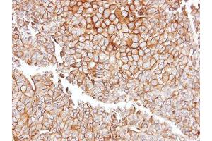 IHC-P Image Immunohistochemical analysis of paraffin-embedded PC13 xenograft, using GGT1, antibody at 1:100 dilution. (GGT1 Antikörper)