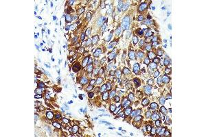 Immunohistochemistry of paraffin-embedded human lung cancer using Cathepsin B Rabbit mAb (ABIN7266148) at dilution of 1:100 (40x lens). (Cathepsin B Antikörper)