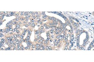 Immunohistochemistry of paraffin-embedded Human liver cancer tissue using AURKA Polyclonal Antibody at dilution of 1:40(x200) (Aurora A Antikörper)