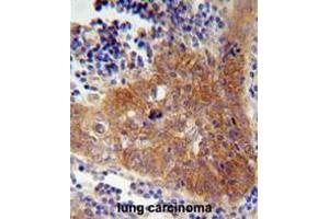 FBXW8 Antibody (Center) immunohistochemistry analysis in formalin fixed and paraffin embedded human lung carcinoma followed by peroxidase conjugation of the secondary antibody and DAB staining. (FBXW8 Antikörper  (Middle Region))