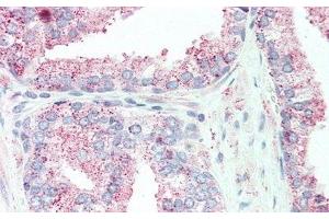 Detection of TNFaIP6 in Human Prostate Tissue using Polyclonal Antibody to Tumor Necrosis Factor Alpha Induced Protein 6 (TNFaIP6) (TNFAIP6 Antikörper  (AA 18-275))