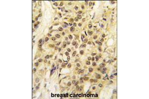 Formalin-fixed and paraffin-embedded human breast carcinoma tissue reacted with MYST1 polyclonal antibody  , which was peroxidase-conjugated to the secondary antibody, followed by DAB staining. (MYST1 Antikörper  (AA 417-446))