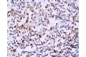 Formalin-fixed and paraffin embedded: human endometrium carcinoma labeled with Anti-Caspase-6 Polyclonal Antibody , Unconjugated 1:200 followed by conjugation to the secondary antibody and DAB staining (Caspase 6 Antikörper  (AA 151-250))