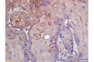 Formalin-fixed and paraffin embedded human laryngeal carcinoma labeled with Rabbit Anti-CD276/B7H3 Polyclonal Antibody, Unconjugated (ABIN1385603) at 1:200 followed by conjugation to the secondary antibody and DAB staining (CD276 Antikörper  (AA 101-200))