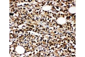 IHC-P: CD10 antibody testing of human B-lymphocyte cancer tissue