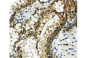IHC-P: HSP70 antibody testing of human intestinal cancer tissue (HSP70 Antikörper  (AA 577-596))
