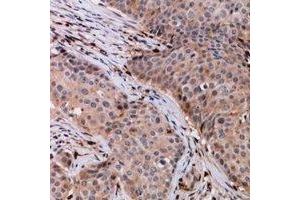 Immunohistochemical analysis of VPS54 staining in human breast cancer formalin fixed paraffin embedded tissue section.