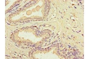 Immunohistochemistry of paraffin-embedded human prostate cancer using ABIN7149154 at dilution of 1:100 (COX1 Antikörper  (AA 474-513))
