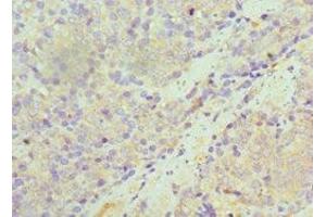 Immunohistochemistry of paraffin-embedded human colon cancer using ABIN7170948 at dilution of 1:100 (SULT1A1 Antikörper  (AA 1-295))