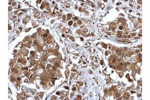 IHC-P Image EPS8 antibody [C3], C-term detects EPS8 protein at cytosol and nucleus on human breast carcinoma by immunohistochemical analysis. (EPS8 Antikörper  (C-Term))