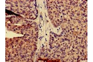 Immunohistochemistry of paraffin-embedded human ovarian cancer using ABIN7146536 at dilution of 1:100