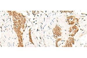 Immunohistochemistry of paraffin-embedded Human esophagus cancer tissue using HOXC13 Polyclonal Antibody at dilution of 1:60(x200) (HOXC13 Antikörper)