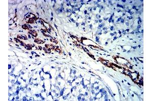 Immunohistochemical analysis of paraffin-embedded bladder cancer tissues using FLI1 mouse mAb with DAB staining. (FLI1 Antikörper  (AA 303-452))