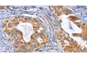 Immunohistochemistry of paraffin-embedded Human cervical cancer using MUSK Polyclonal Antibody at dilution of 1:30 (MUSK Antikörper)