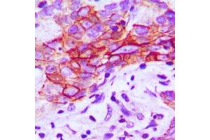 Immunohistochemical analysis of CMKLR1 staining in human breast cancer formalin fixed paraffin embedded tissue section. (CMKLR1 Antikörper  (Center))