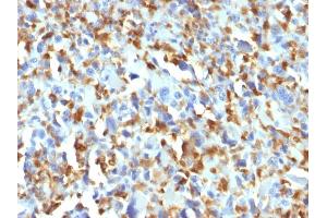 Formalin-fixed, paraffin-embedded human Histiocytoma stained with Factor XIIIa Mouse Monoclonal Antibody (F13A1/1683). (F13A1 Antikörper  (AA 46-181))