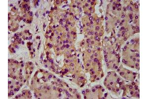 IHC image of ABIN7145642 diluted at 1:200 and staining in paraffin-embedded human pancreatic cancer performed on a Leica BondTM system. (BMPER Antikörper  (AA 271-418))