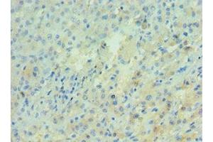 Immunohistochemistry of paraffin-embedded human liver cancer using ABIN7143277 at dilution of 1:100 (APRT Antikörper  (AA 1-180))