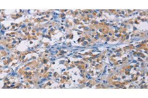 Immunohistochemistry of paraffin-embedded Human thyroid cancer tissue using RICTOR Polyclonal Antibody at dilution 1:50 (RICTOR Antikörper)