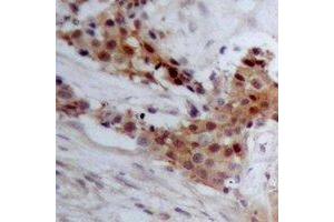 Immunohistochemical analysis of BAP1 staining in human breast cancer formalin fixed paraffin embedded tissue section. (BAP1 Antikörper)