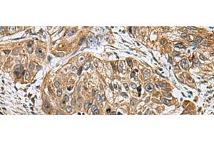 Immunohistochemistry of paraffin-embedded Human esophagus cancer tissue using EARS2 Polyclonal Antibody at dilution of 1:30(x200) (EARS2 Antikörper)
