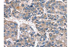 The image on the left is immunohistochemistry of paraffin-embedded Human liver cancer tissue using ABIN7190040(CACNA1G Antibody) at dilution 1/20, on the right is treated with synthetic peptide. (CACNA1G Antikörper)