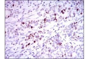 Immunohistochemical analysis of paraffin-embedded cervical cancer tissues using INCENP mouse mAb with DAB staining. (INCENP Antikörper  (AA 369-583))