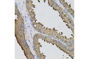 Immunohistochemistry of paraffin-embedded human prostate using SUMO3 antibody (ABIN5971585) (40x lens). (SUMO3 Antikörper)