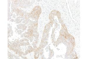 Immunohistochemistry (IHC) image for anti-Met Proto-Oncogene (MET) (C-Term) antibody (ABIN7795683) (Rekombinanter c-MET Antikörper  (C-Term))