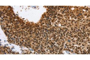 Immunohistochemistry of paraffin-embedded Human lung cancer using ELAVL1 Polyclonal Antibody at dilution of 1:40 (ELAVL1 Antikörper)