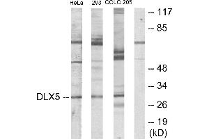 Immunohistochemistry analysis of paraffin-embedded human lung carcinoma tissue using DLX5 antibody. (DLX5 Antikörper)