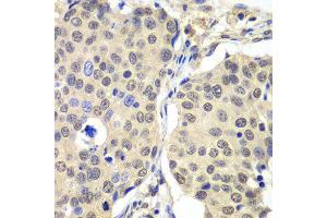 Immunohistochemistry of paraffin-embedded human lung cancer using CCNC antibody at dilution of 1:100 (x40 lens). (Cyclin C Antikörper)