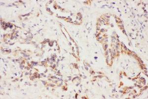 Anti-Eotaxin 3 Picoband antibody,  IHC(P): Human Lung Cancer Tissue