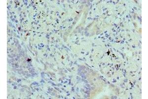 Immunohistochemistry of paraffin-embedded human lung cancer using ABIN7145292 at dilution of 1:100 (BIK Antikörper  (AA 1-130))