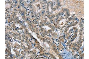 The image on the left is immunohistochemistry of paraffin-embedded Human thyroid cancer tissue using ABIN7192312(SEPN1 Antibody) at dilution 1/20, on the right is treated with synthetic peptide. (Selenoprotein N Antikörper)