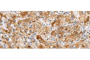 Immunohistochemistry of paraffin-embedded Human liver cancer tissue using NMU Polyclonal Antibody at dilution of 1:80(x200) (Neuromedin U Antikörper)