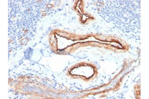 Formalin-fixed, paraffin-embedded human Renal Cell Carcinoma stained with MTF1 Mouse Monoclonal Antibody (MTF1/2649). (MTF1 Antikörper)